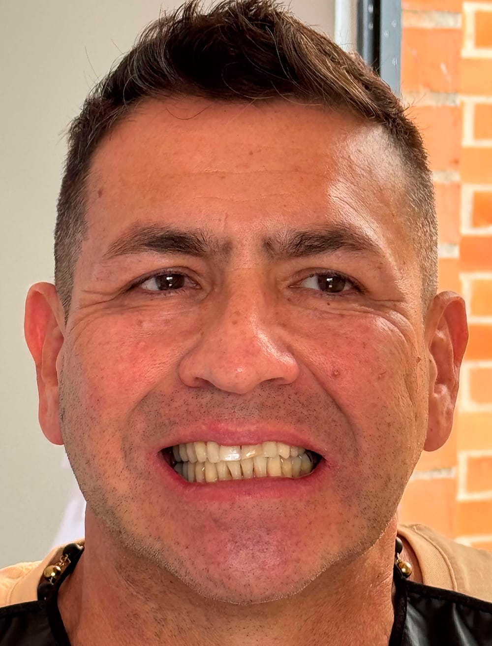 Metal-Free Ceramic Crowns