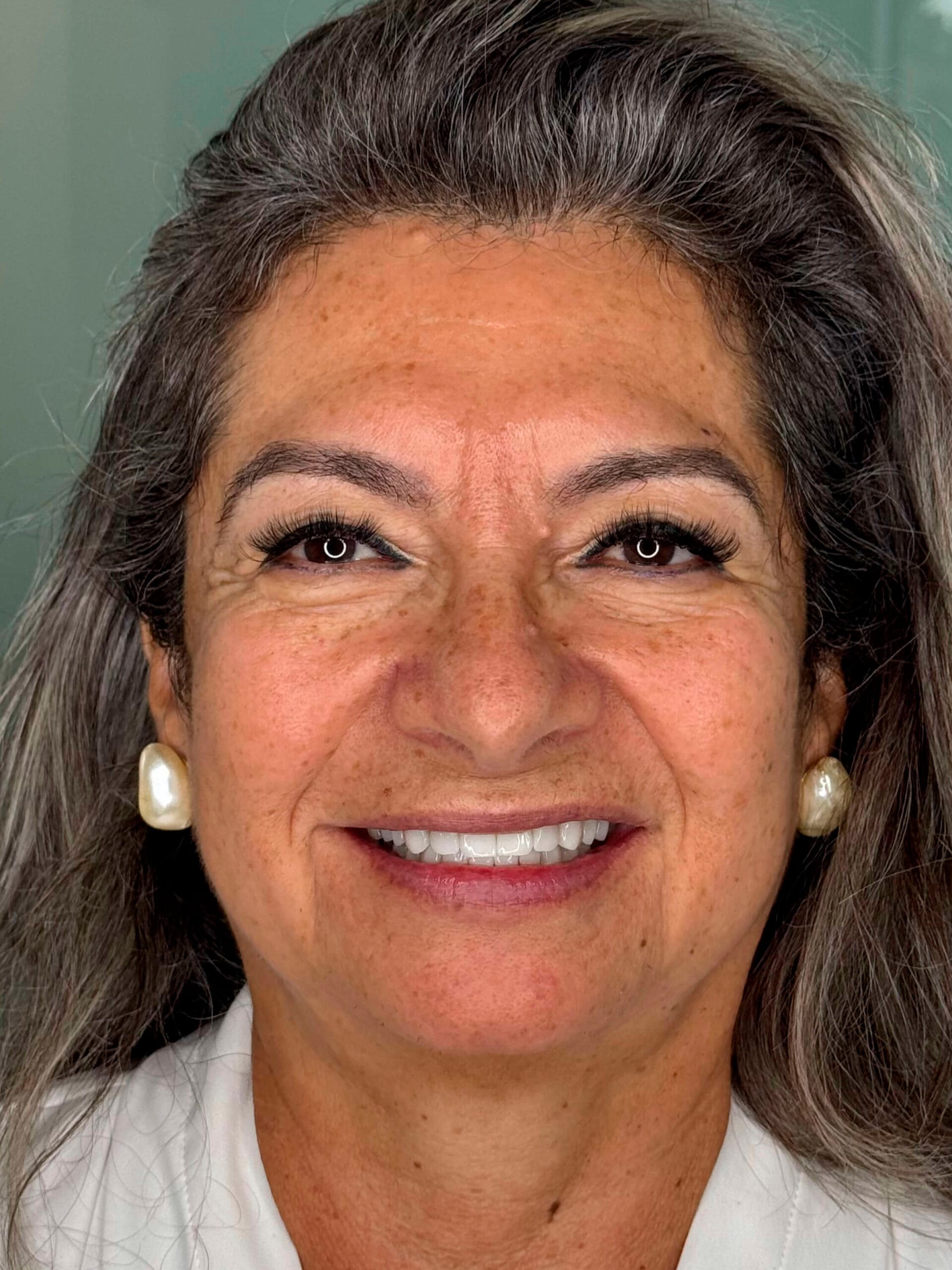Metal-Free Ceramic Crowns