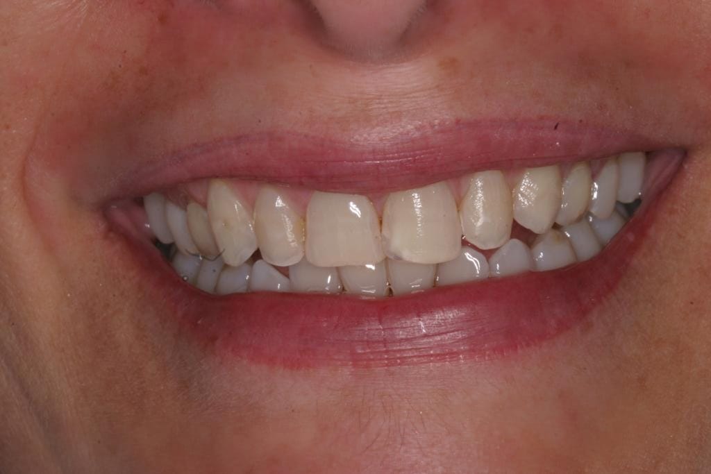 Diseño de Sonrisa con Alta Resina