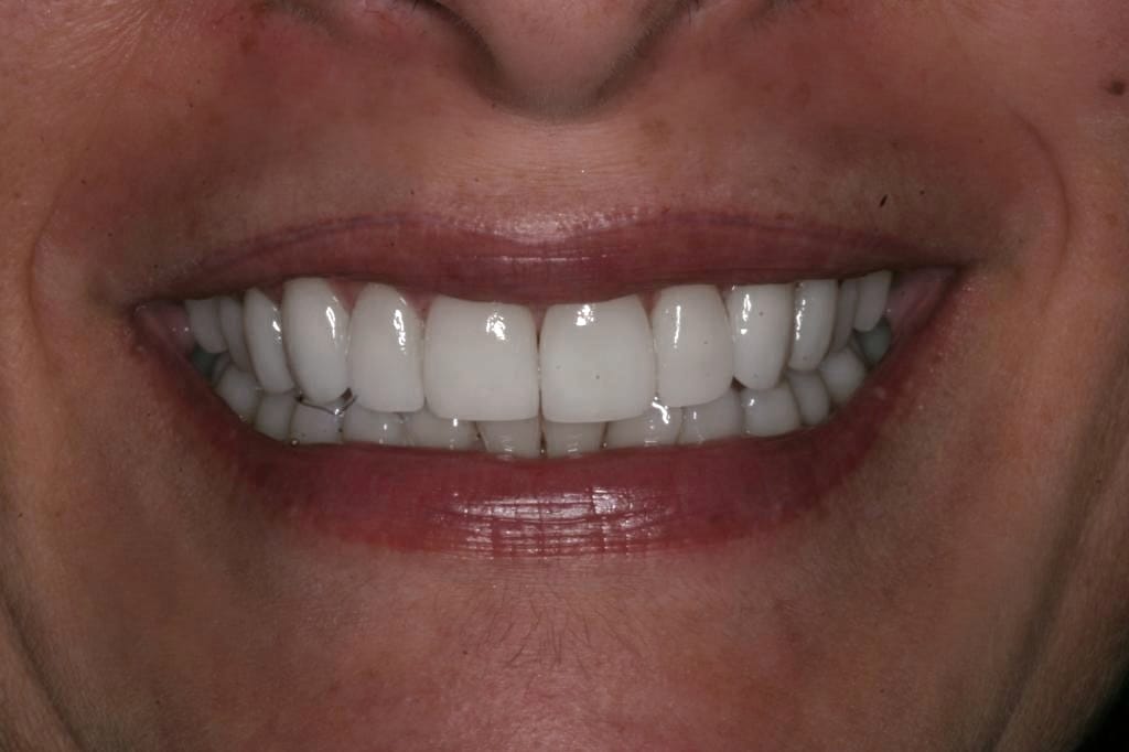 Diseño de Sonrisa con Alta Resina