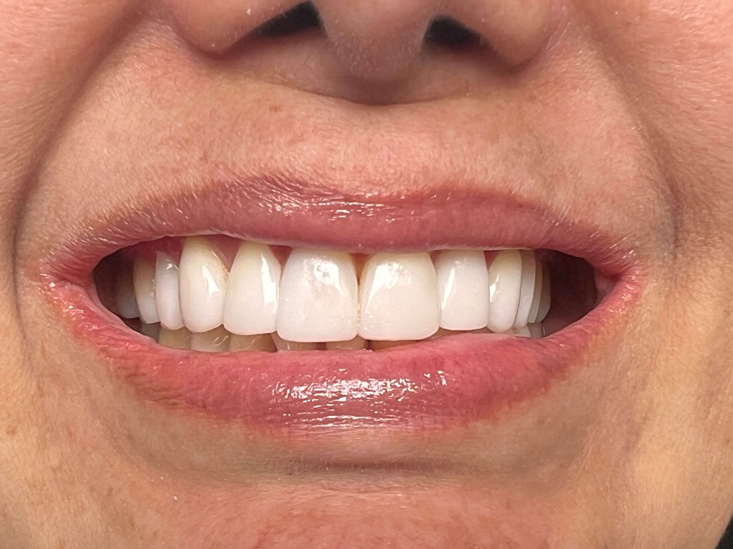 Diseño de Sonrisa con Alta Resina