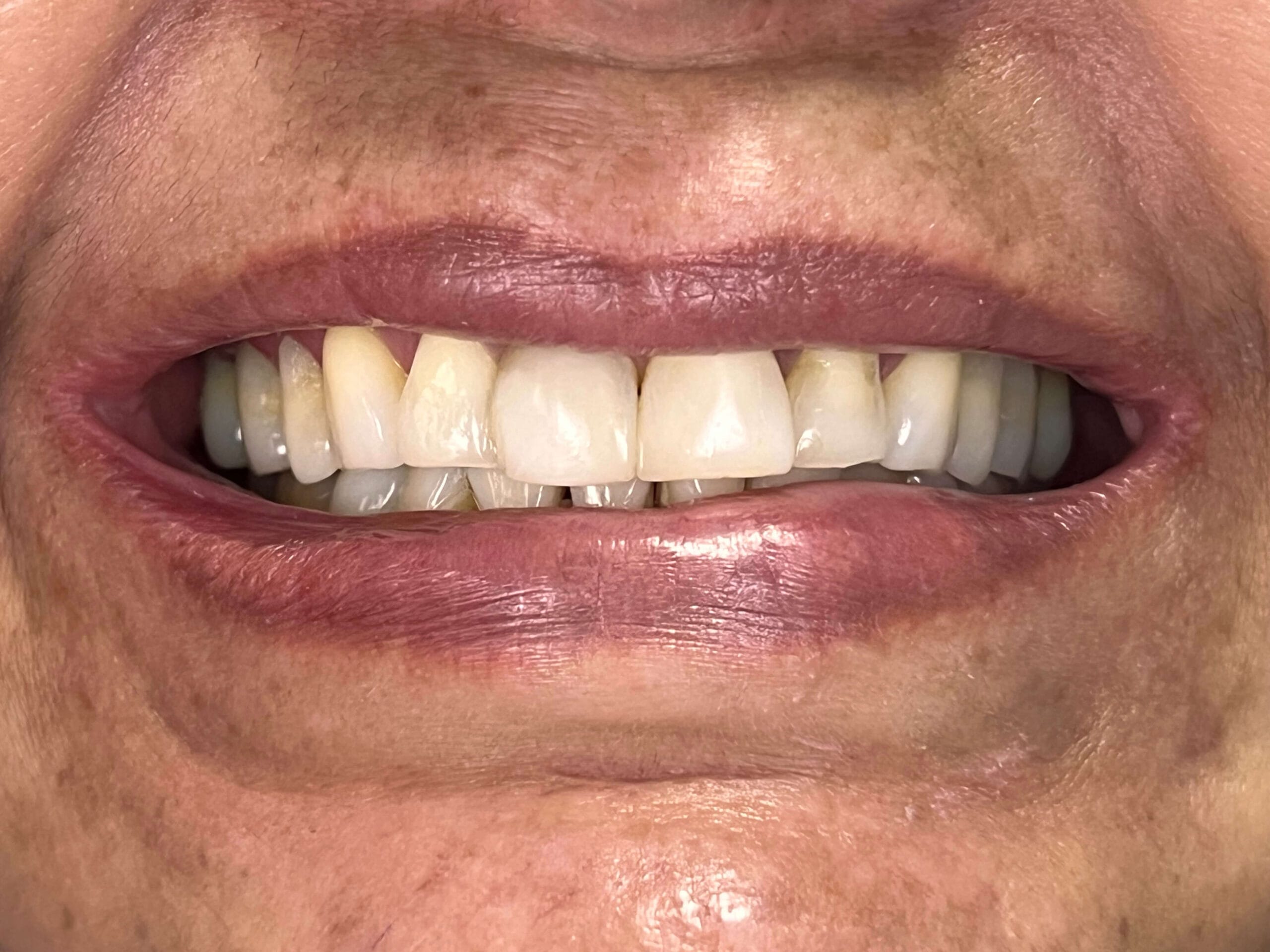 Diseño de Sonrisa con Alta Resina