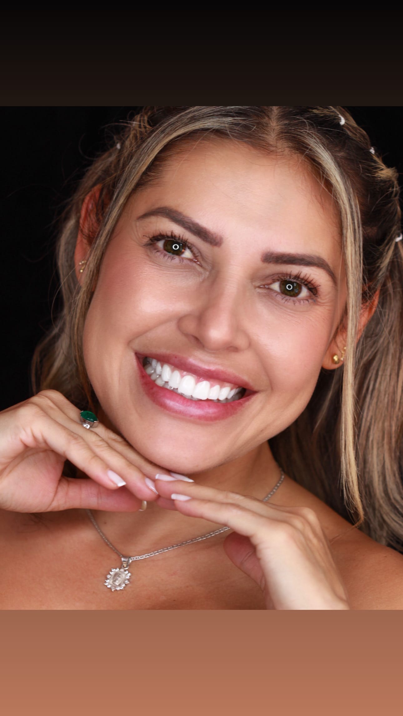 Diseño de Sonrisa con Alta Resina