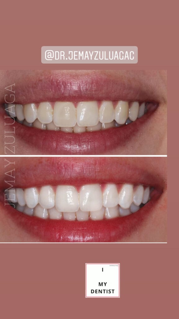 Dental Whitening
