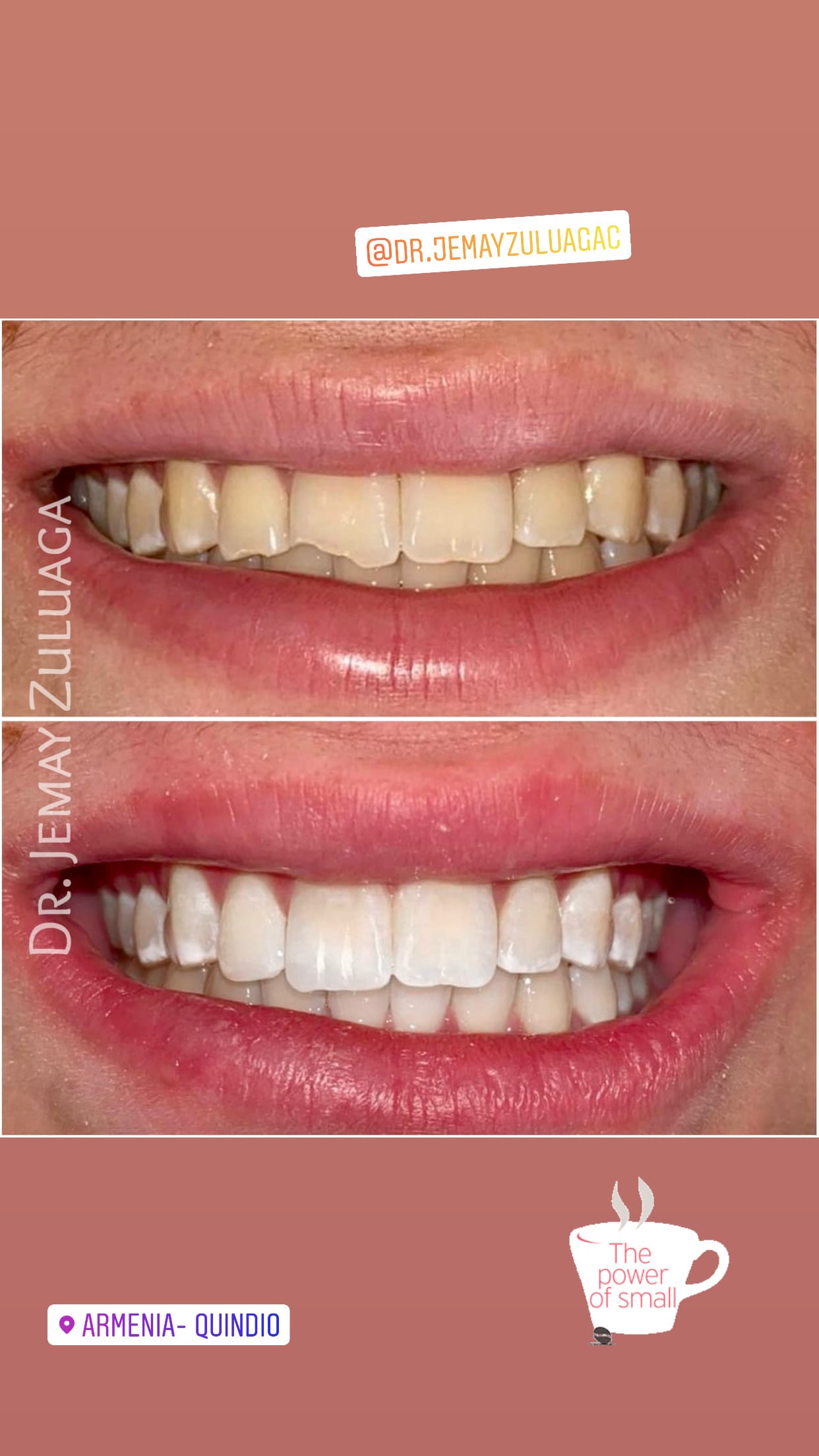 Dental Whitening