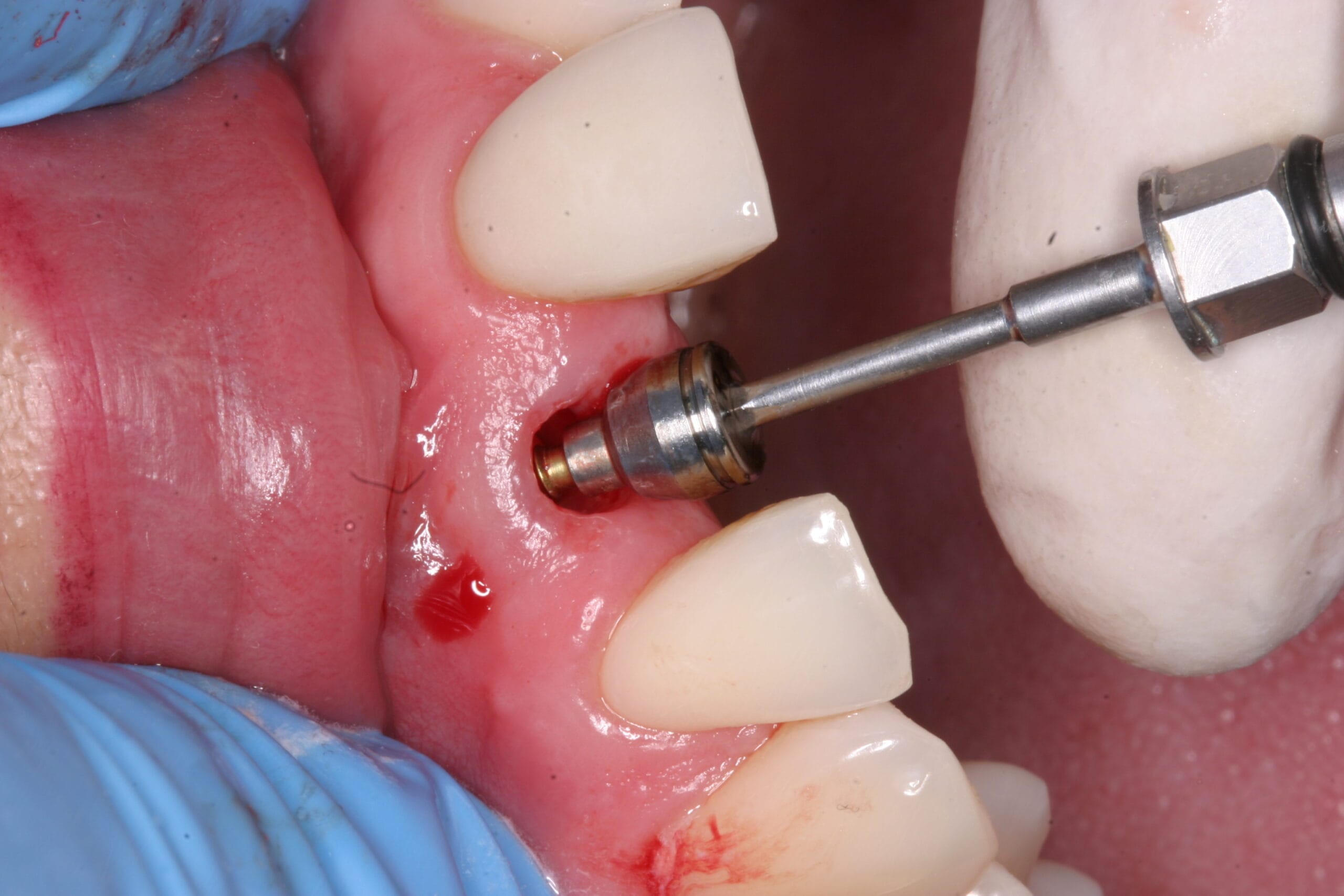 Dental Implants in Colombia