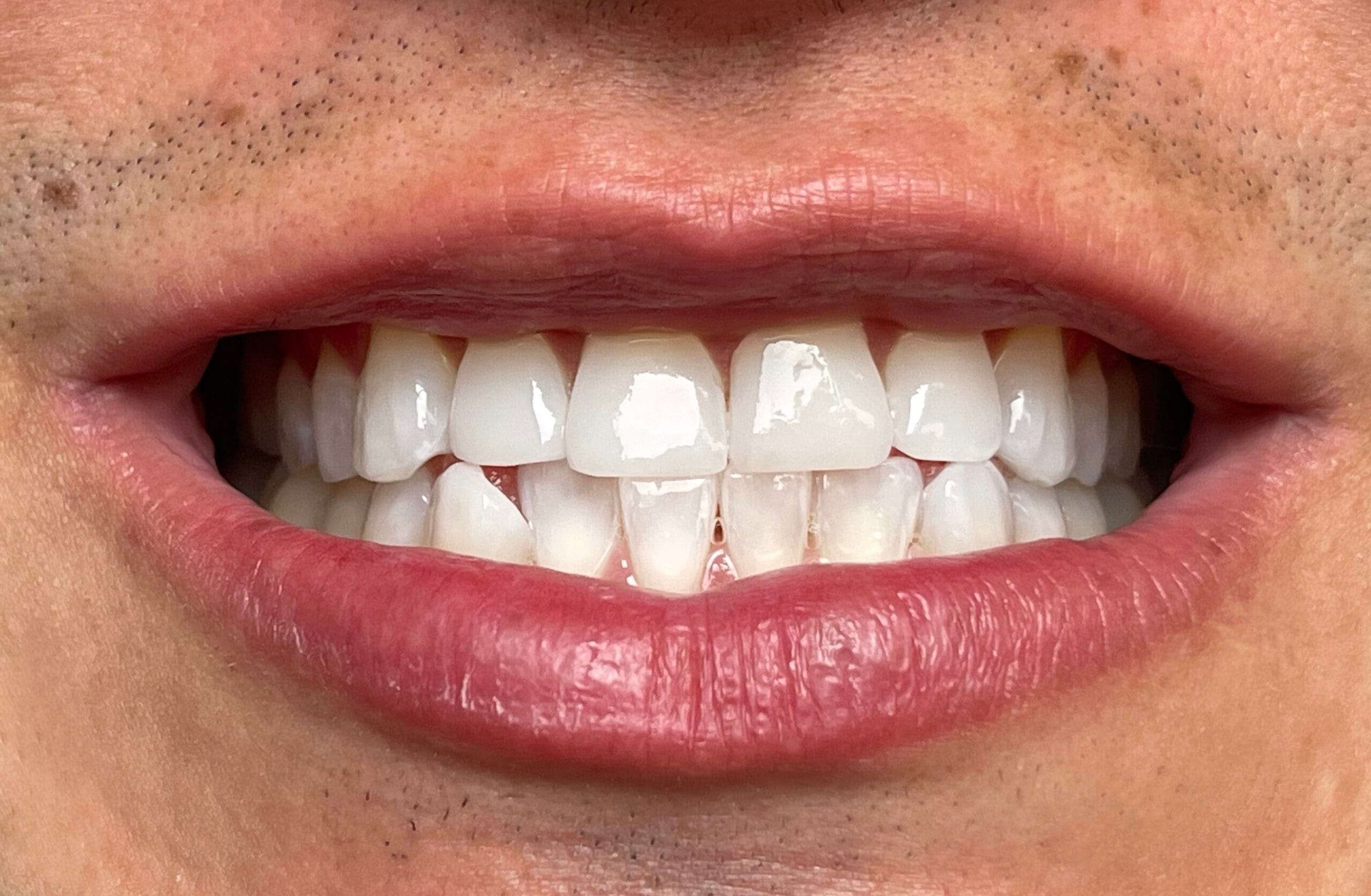 Diseño de Sonrisa con Alta Resina