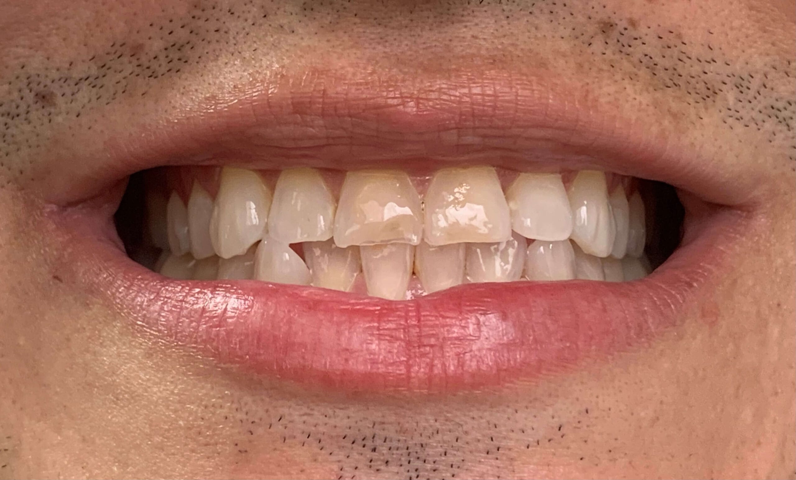 Diseño de Sonrisa con Alta Resina