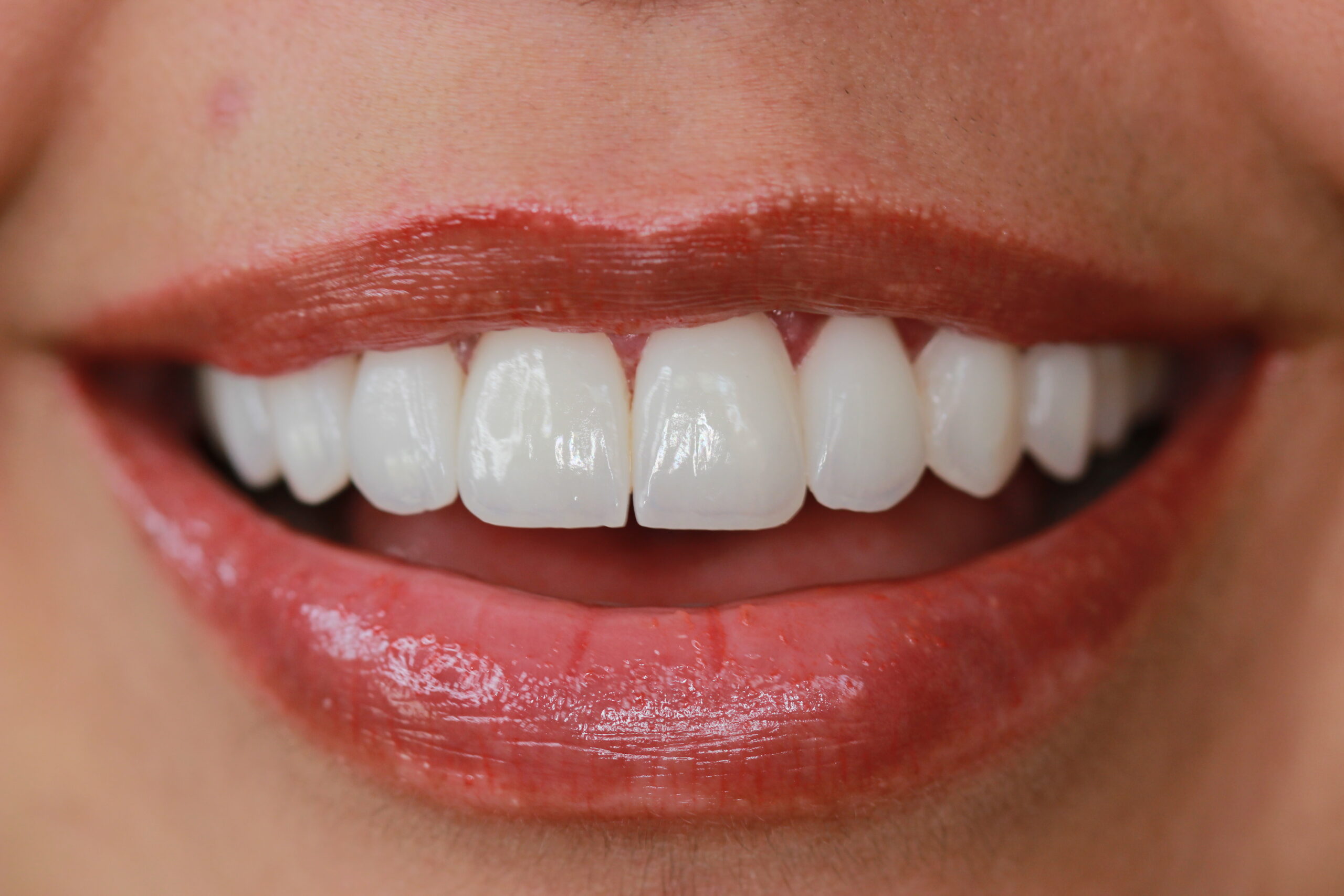 Blog 1 Dental Tourism in Armenia, Colombia: Discover a New Destination for Your Smile Design